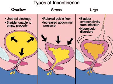 URINARY INCONTINENCE UroConsult