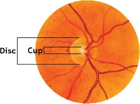 Optic disc and optic cup in fundus image. Reproduced with permission ...