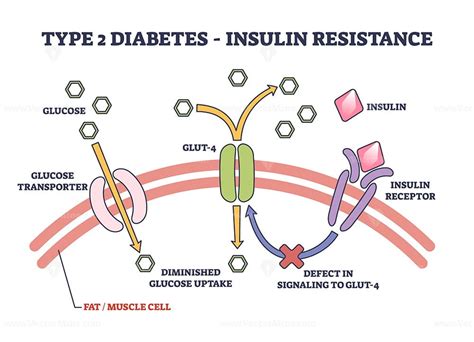 Type 2 Diabetes And Insulin Resistance Anatomical Explanation Outline Diagram Vectormine