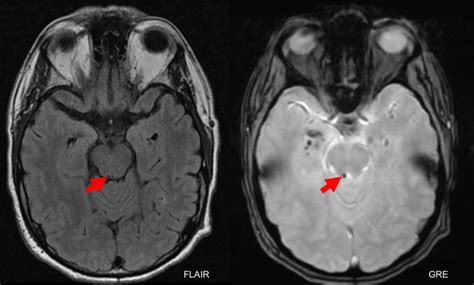 Fourth Nerve Palsy Case Based Neuro Ophthalmology