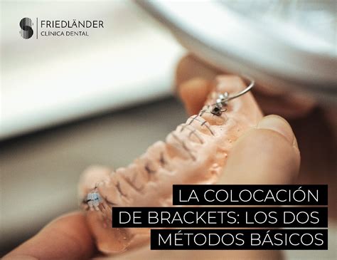 Colocación de los brackets Métodos básicoss en odontología