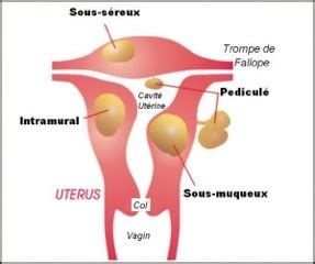 Le Fibrome Pathologie