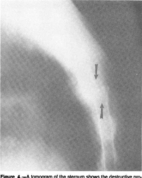Figure 1 From Primary Sternal Osteomyelitis Semantic Scholar