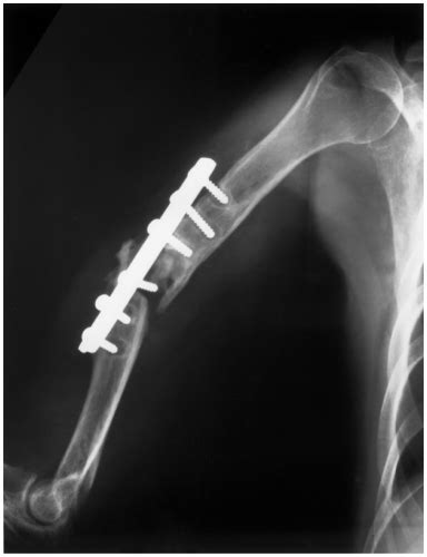 Humeral Shaft Fractures Radiology Key