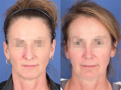 Revision Rhinoplasty Before And After 16 Weber Facial Plastic Surgery