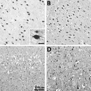 Representative Photomicrographs Of Cases With Pid And Ftld