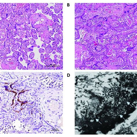 Placental pathology findings of the two cases. The Placenta of case 1 ...