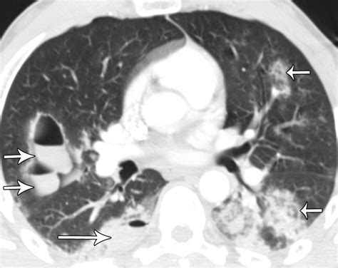 Multidetector CT Of Blunt Thoracic Trauma RadioGraphics