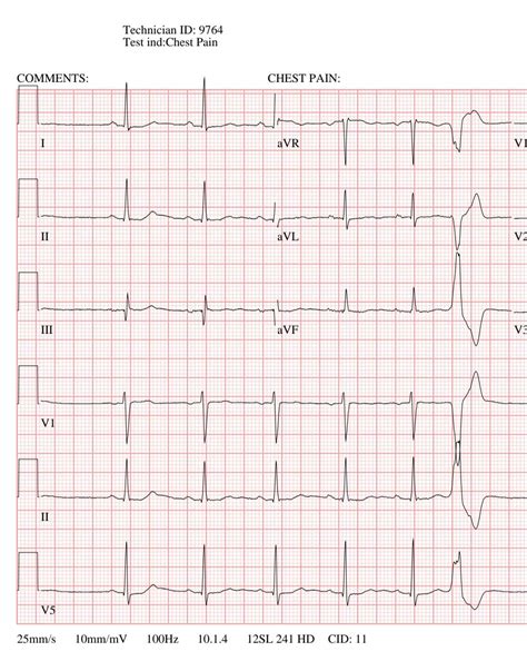 help with ekg doc didn't report on it : r/PVCs