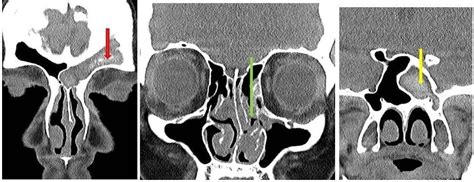 Fungal Sinusitis Sinushealth