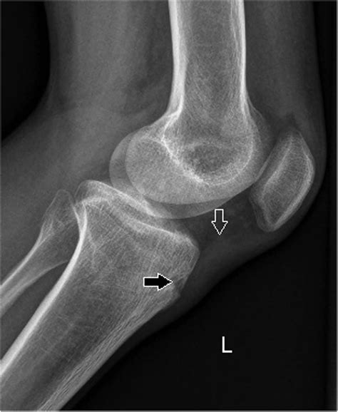Knee Tibial Tendonitis