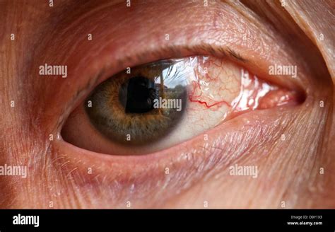 Blood Shot Eye after laser surgery to a Detached Retina Stock Photo, Royalty Free Image ...