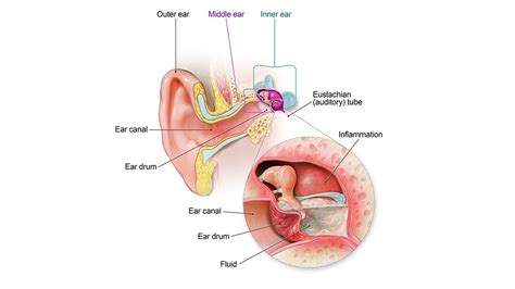 Ear Infection Basics | Ear Infection | CDC