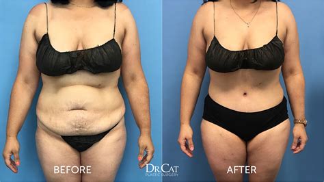 7 Life Changing Benefits Of A Tummy Tuck Dr Cat Begovic Beverly Hills