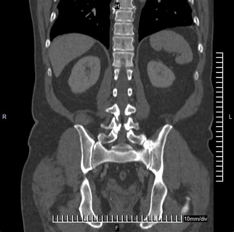 Coronal Abdomen 5 Diagram Quizlet