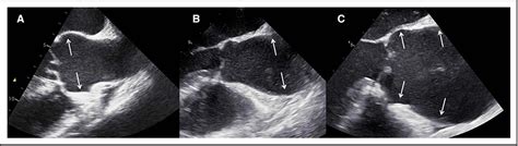 Figure 1 From Sex Differences In Phenotypes Of Bicuspid Aortic Valve