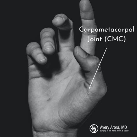 Understanding Thumb Arthritis: Causes, Symptoms, and Treatment - Arora Hand Surgery