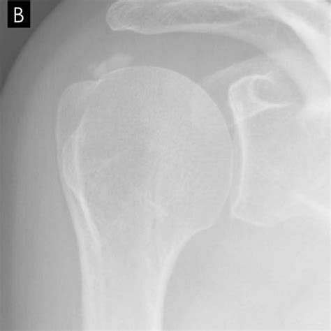 Arthroscopic Removal Of Rotator Cuff Calcium Deposits Doctor Matthieu