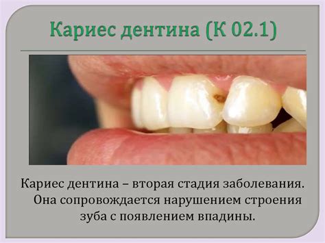 Кариес зуба - online presentation