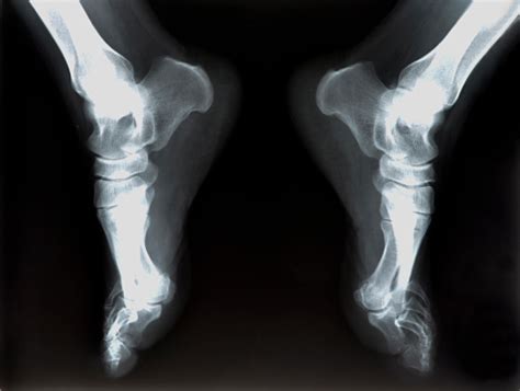 Xray Of Foot Stock Photo - Download Image Now - Adult, Adults Only, Anatomy - iStock