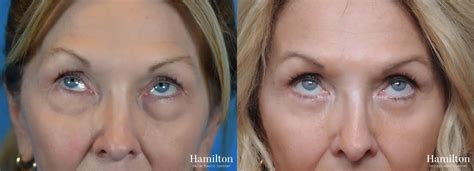 Blepharoplasty Before & After Gallery