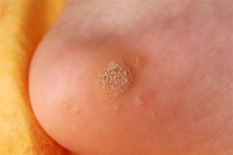 What You Should Know About Plantar Warts Healthy Ideal