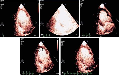 Ultrasound Enhanced Stress Echocardiography Clinical Tree