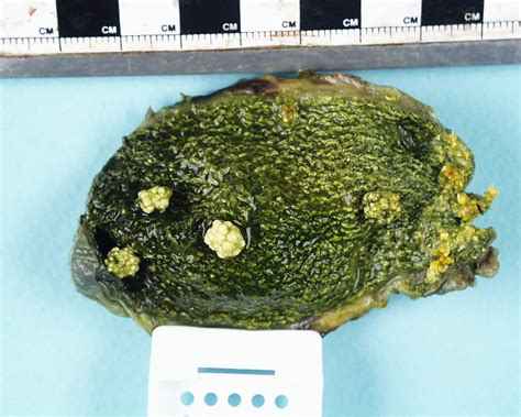 Gallstones And Cholecystitis