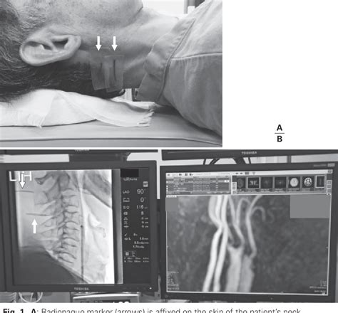 Figure 1 From Percutaneous Ultrasonography Guided Carotid Artery