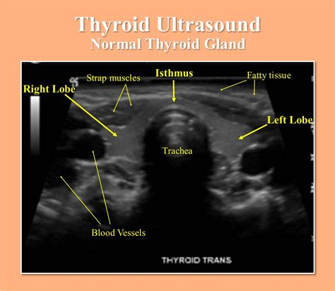 Ultrasound Of Thyroid Gland