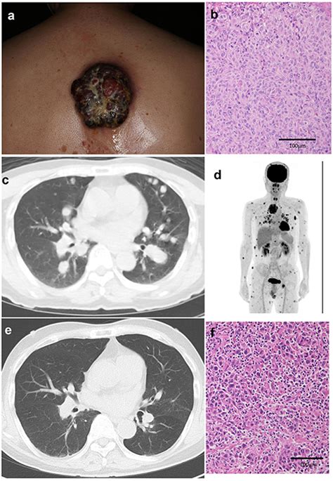 Frontiers Successful Treatment Of Unresectable Advanced Melanoma By