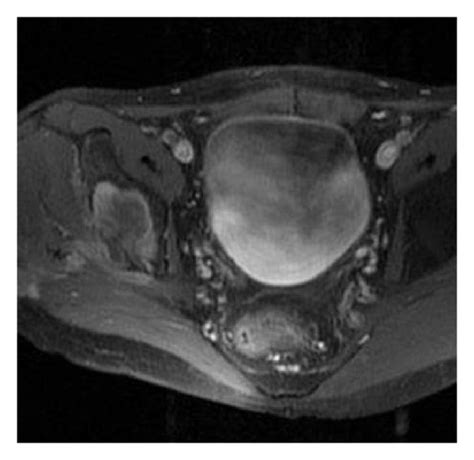 A Preoperative Anteroposterior Radiograph Of The Pelvis Of A