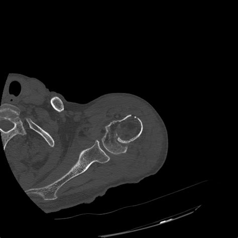 Lipohemarthrosis Of The Shoulder Image