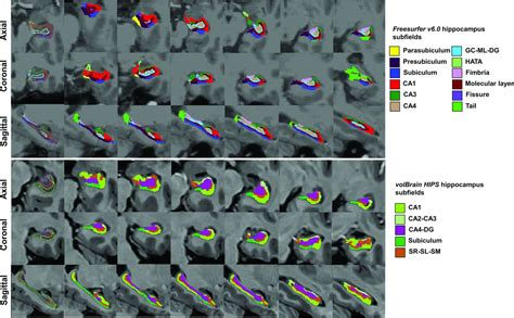 Comparison Of Hippocampal Subfield Segmentation Agreement Between 2