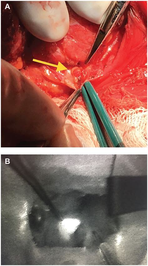 Ultrasound Identification Of Normal Parathyroid Glands Samuel M