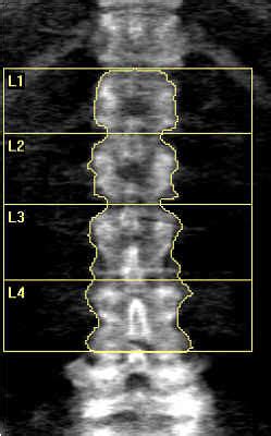 DXA Bone Density San Antonio Inside Outside Wellness Center