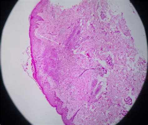 Figure 1 From Simultaneous Occurrence Of Papulonecrotic Tuberculid And