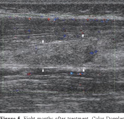 Figure 1 From Real Time Ultrasound Guided Ethanol Sclerotherapy Of A