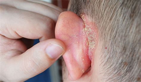 What You Need To Know About That Lump Behind Your Ear CureJoy