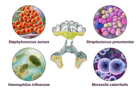 Anatomía de rinosinusitis y bacterias que causan sinusitis