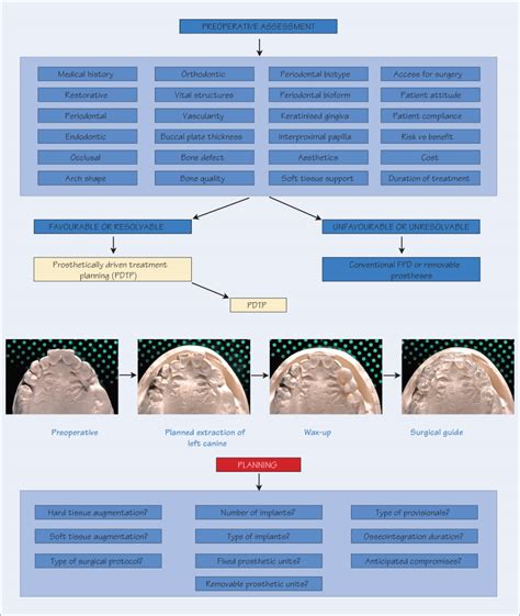 50 Implants: treatment planning | Pocket Dentistry