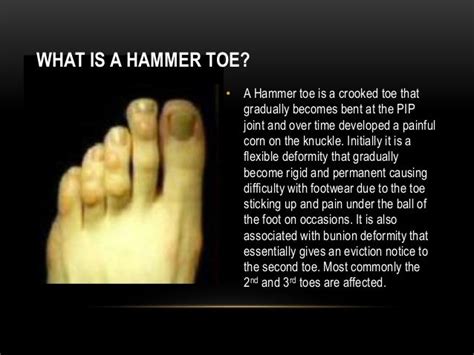 Hammer Toe Surgery Modern Day Toe Operation