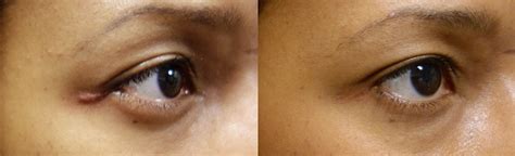 Ectropion After Lower Blepharoplasty