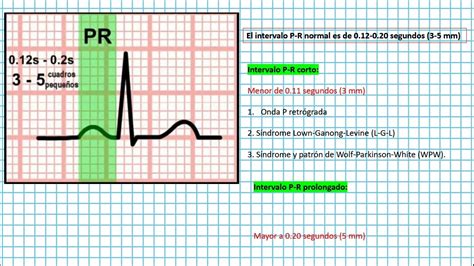 Intervalo P R Clases Ekg Youtube