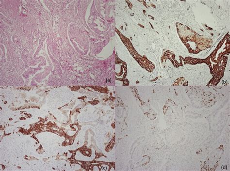 Histology Samples Of The ASCP Patient 1 Stain Hematoxylin Eosin A