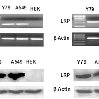 Expression Study Of Mdr Mrna And Proteins Expression Of Lrp And Mrp