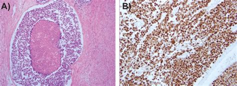 A Histologic Finding Of Large Cell Neuroendocrine Carcinoma The