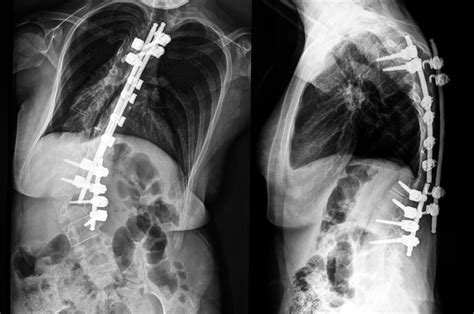 Scoliosis Surgery - Scoliosis Solutions