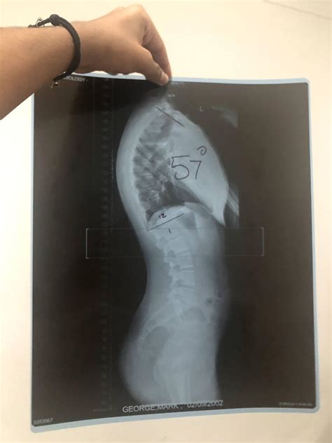 Is surgery an option? : r/kyphosis