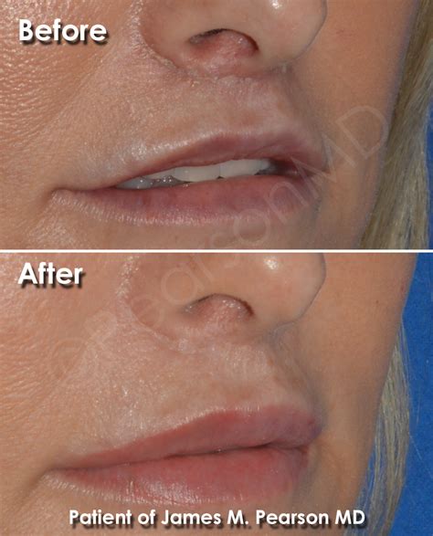 Corner Lip Lift Dr James Pearson Facial Plastic Surgery